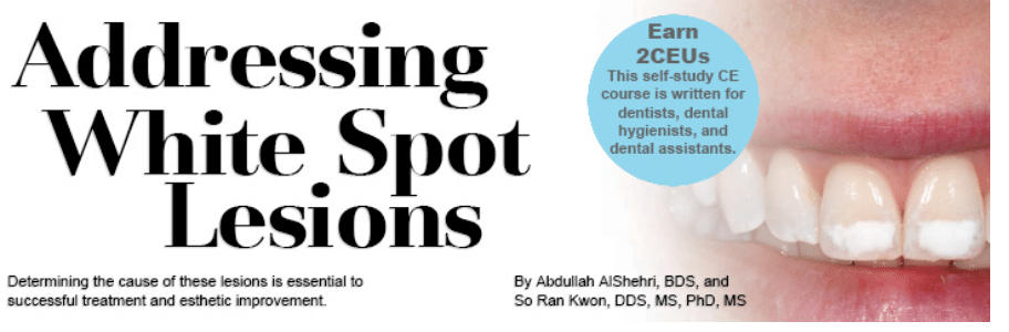 White Spot Lesions Natural Teeth