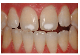 Addressing White Spot Lesions In Natural Dentition