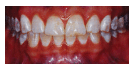 White Spot Lesions Preoperative View