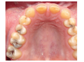 Tooth Anomalies