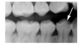 Tooth Anomalies