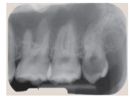 Tooth Anomalies Third Molar