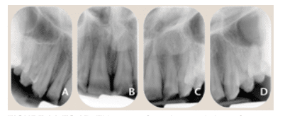 Tooth Anomalies