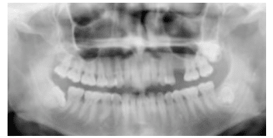 Tooth Anomalies