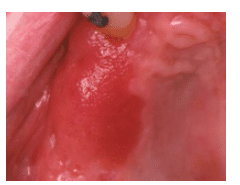 Signs of Oral Cancer
