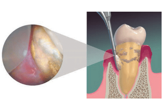 subgingival calculus