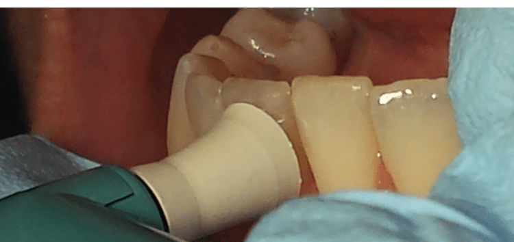 toothpaste to remove stains from porcelain crowns