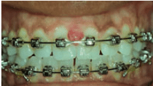 Gingival Lesion during Pregnancy 