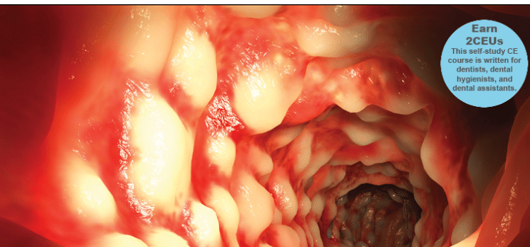 Recognizing the Signs Of Crohn's Disease - Dimensions of Dental Hygiene