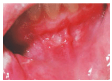 Early Sign of Crohn's disease