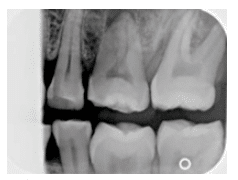 Receptor Placement Technique