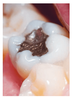 Dental Amalgam Fillings