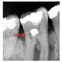 Internal Tooth Resorption