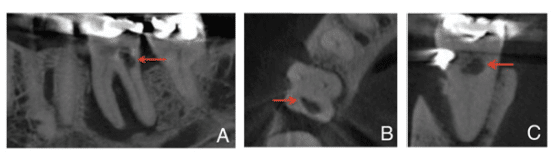 Internal Tooth Resorption