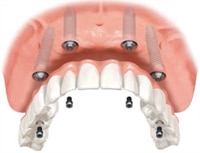 Fixed Hybrid Denture Implant