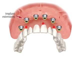 Fixed Implant Supported Bridge