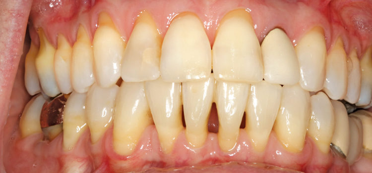 0717_gingival_header