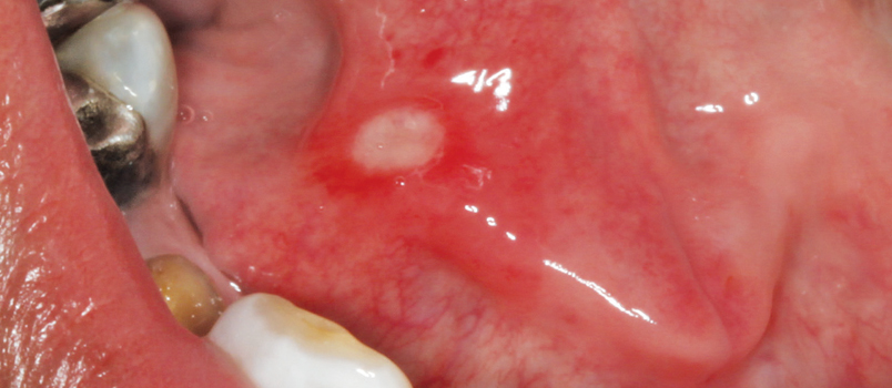 ulcer on floor of mouth