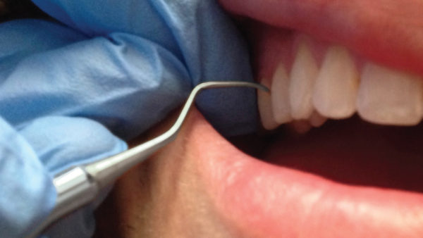 Instrument Selection for Premolar Teeth and Periodontal Maintenance