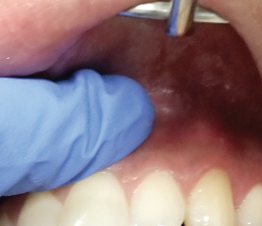 Endodontic Diagnosis for the Dental Hygienist