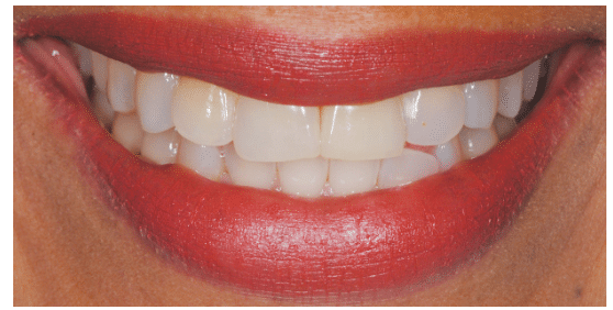 Tooth Discoloration Evaluation