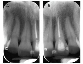 X-ray for Dark Teeth Treatment