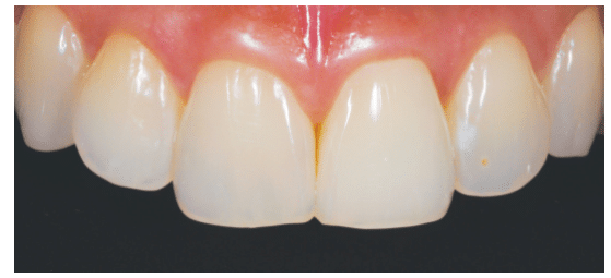 Tooth Discoloration After 2-Week Treatment