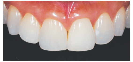 Tooth Discoloration Treatment