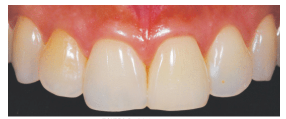 Tooth Discoloration Preclinical View