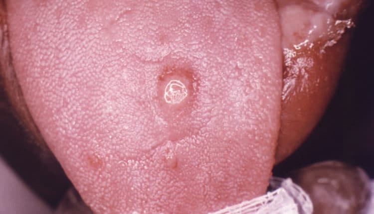 rhagades syphilis