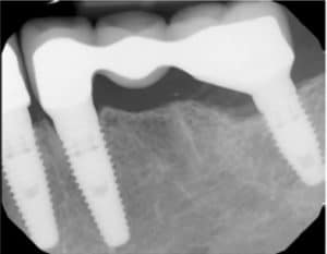 Dental Implants Image