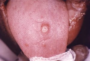 Image of Syphilis