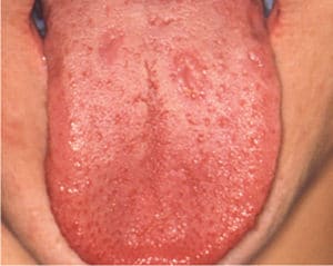 Lesions Confirmed Syphilis