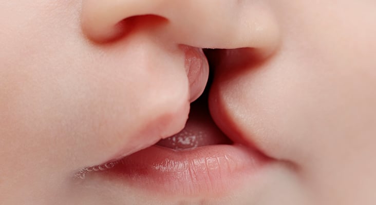 baby with lip cleft close up on lips