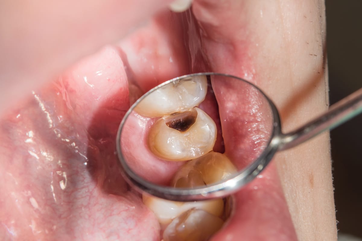 close up of dental cavity