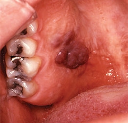 HIV clinical presentation