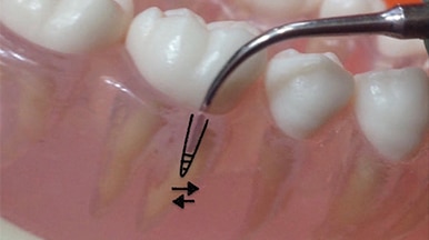 Ultrasonic in narrow pockets