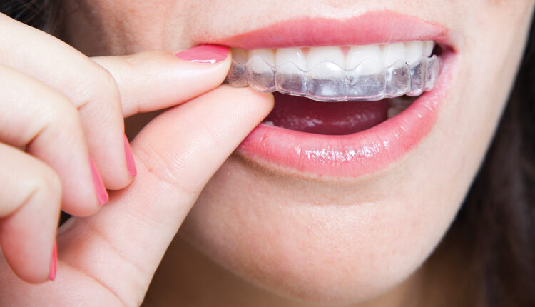 Invisalign Vs Braces: Which One Should You Choose? - Center for