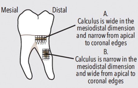 Channeling for first molar teeth