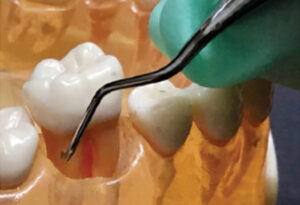 Instrumentation on first molar teeth