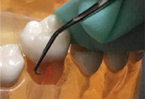 Instrumentation on first molar teeth