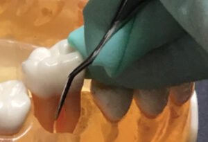 Instrumentation on first molar teeth