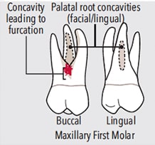 Maxillary first molar