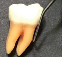 Mandibular first molar