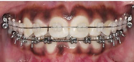 Conventional orthodontics