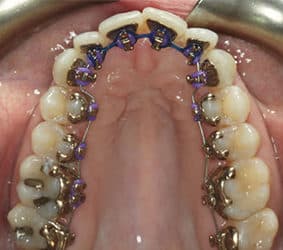 Traditional orthodontics