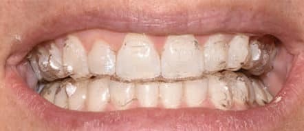 Clear aligners