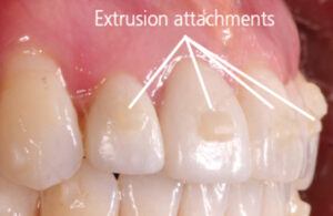 Bonded composite on teeth