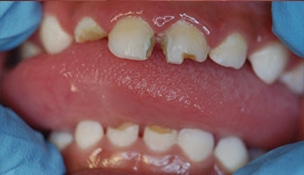 Severe early childhood dental caries.