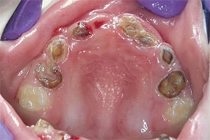 Severe early childhood dental caries